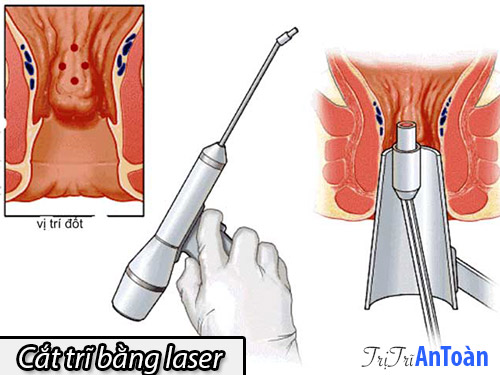 cắt trĩ bằng phương pháp laser